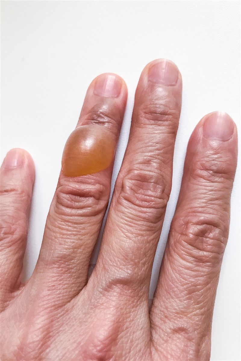 Traiter un lipome
