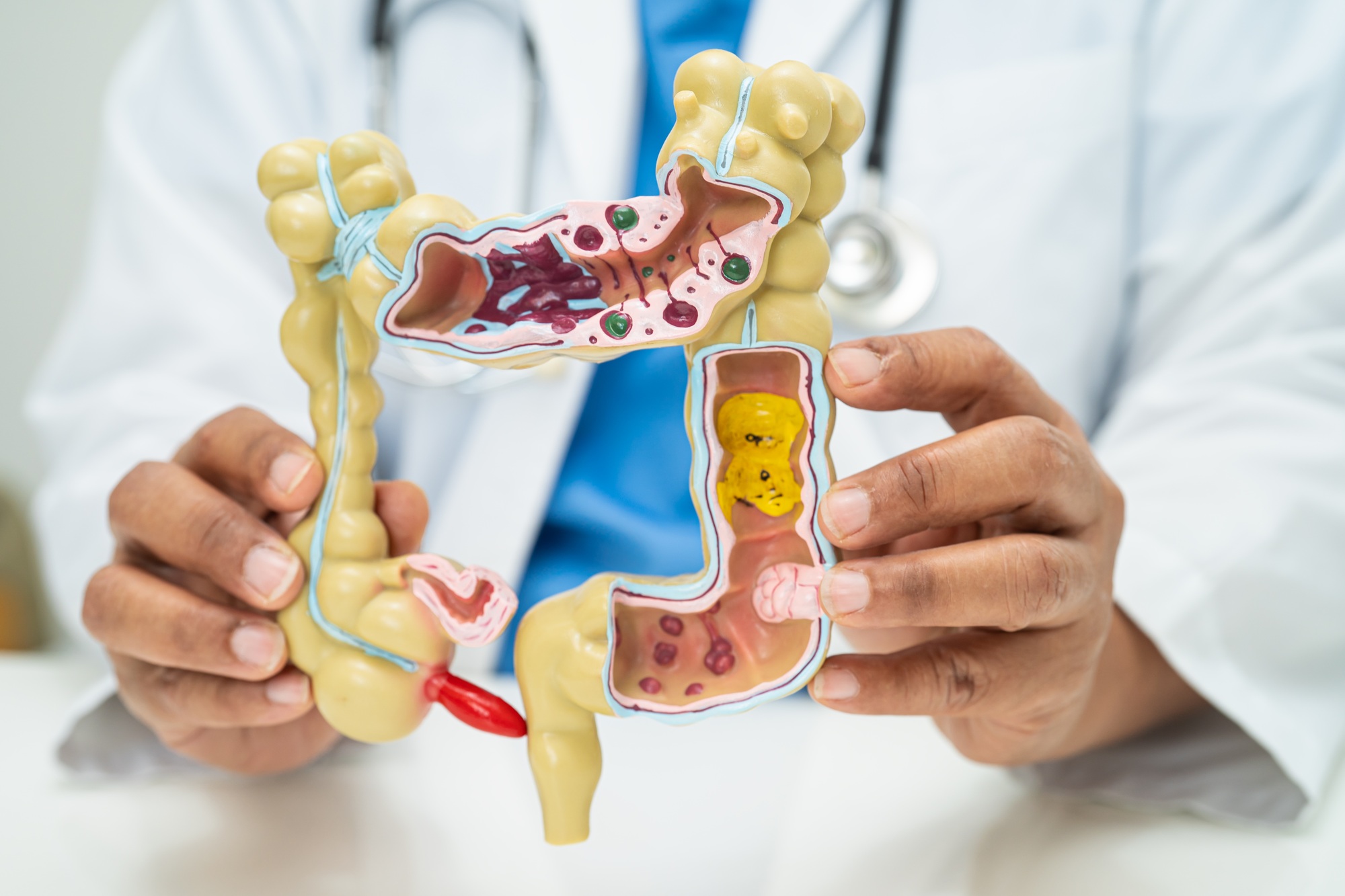 Intestine, appendix and digestive system, doctor holding anatomy model for study diagnosis