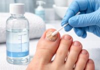 Comment appliquer le traitement efficace à la javel pour une mycose à l’ongle du pied en toute sécurité Comment appliquer le traitement efficace à la javel pour une mycose à l’ongle du pied en toute sécurité