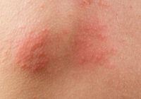 Peau atopique définition : explication claire Peau atopique définition : explication claire