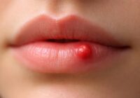 Boule de sang sur la lèvre : symptômes et signes d’alerte à surveiller Boule de sang sur la lèvre : symptômes et signes d’alerte à surveiller